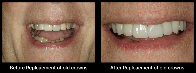 Porcelain Crowns Before After