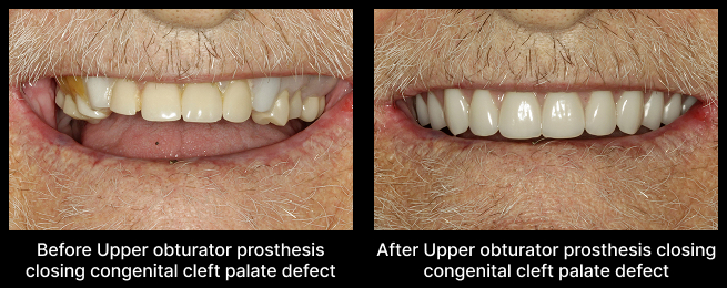 Prosthesis Closing Before After