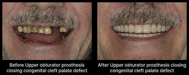 Prosthesis Closing Before After