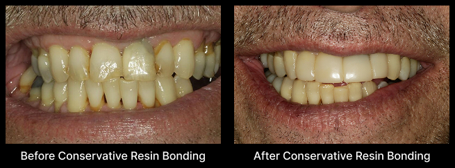 Resin Bonding Before After